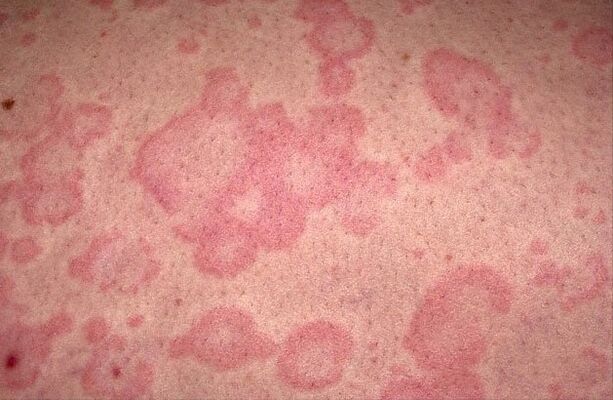 Alergia a los parásitos